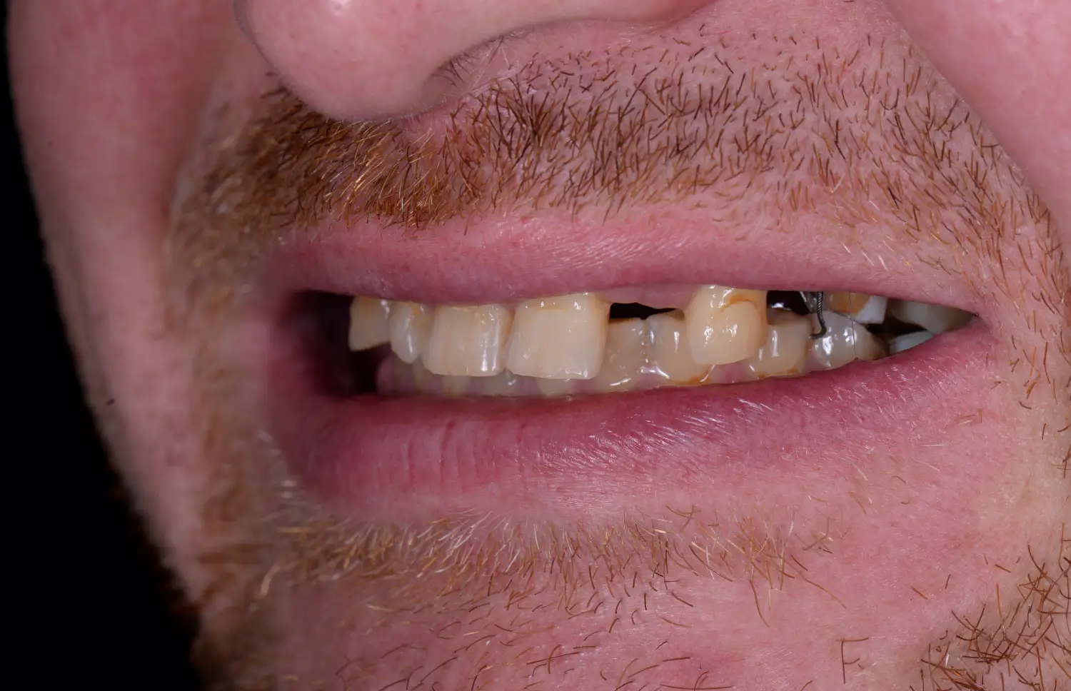 Before treatment outcome