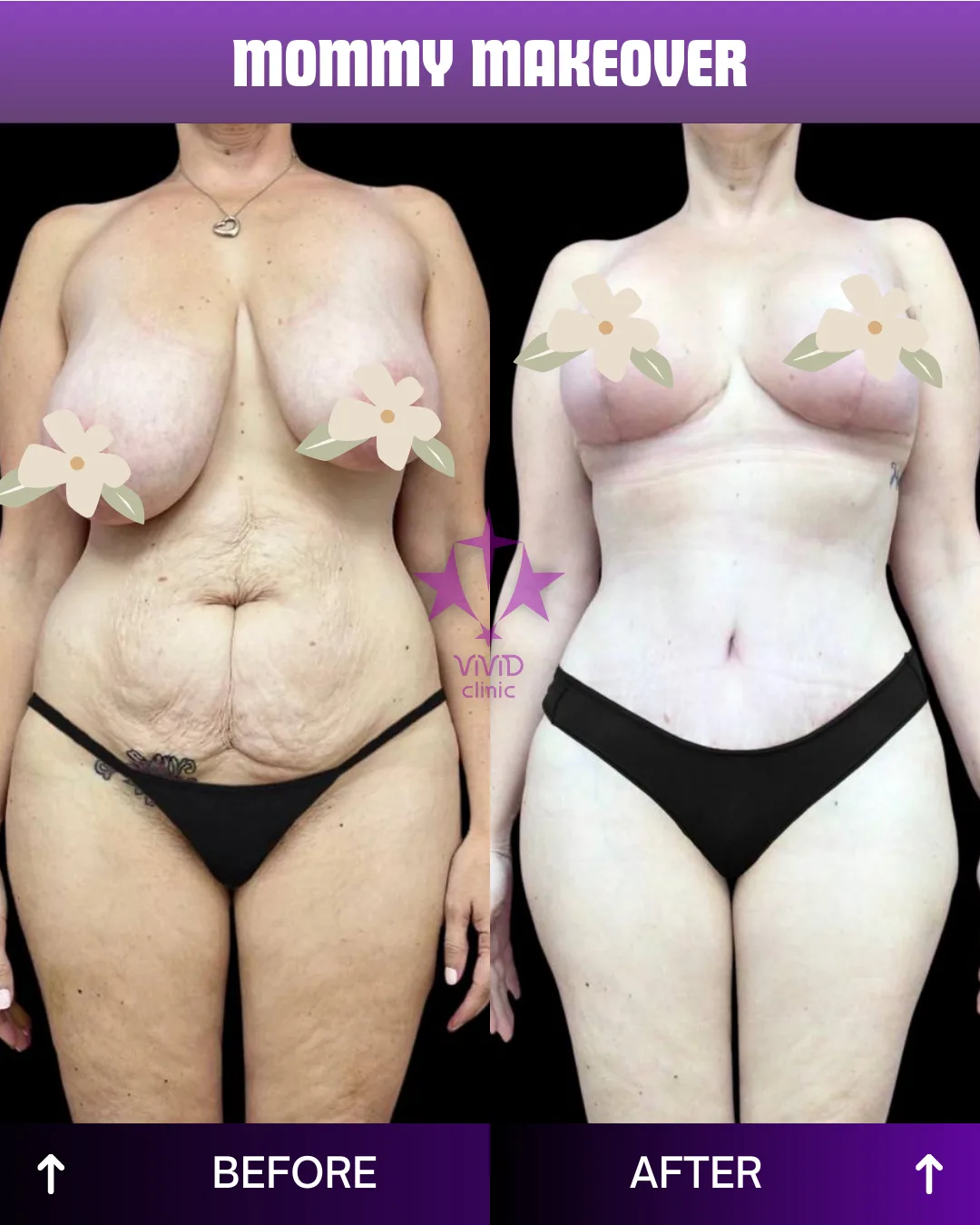 Transform Your Look with a Mommy Makeover in Istanbul