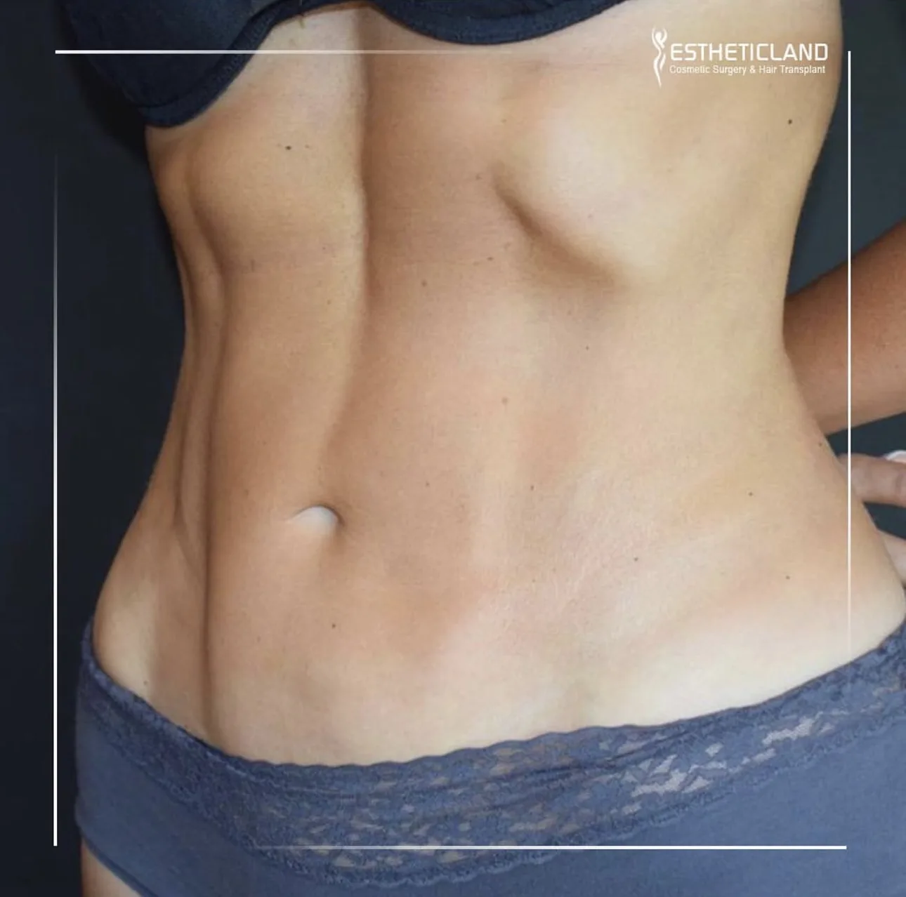 Transform Your Look: The Mommy Makeover Experience in Istanbul