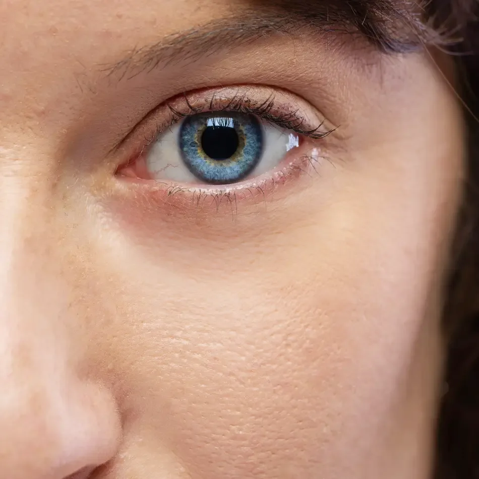 Eyelid Surgery before treatment comparison image