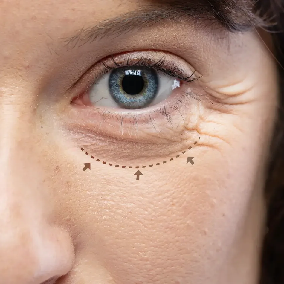 Eyelid Surgery after treatment comparison image