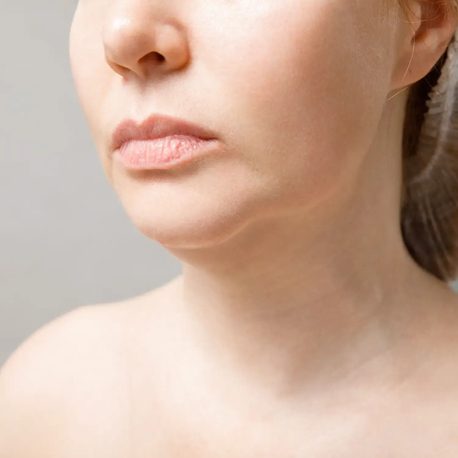 Neck Lift after treatment comparison image
