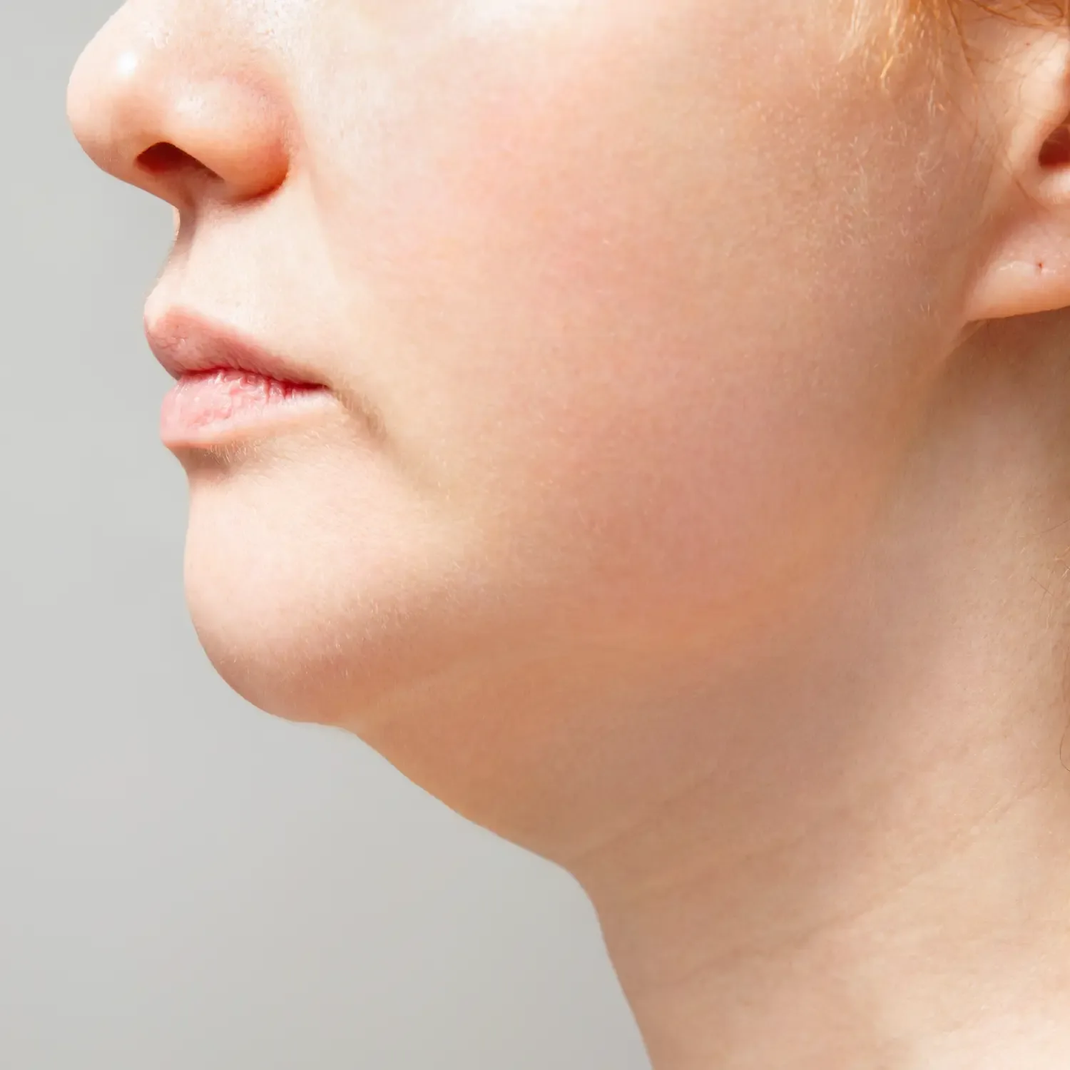 Neck Lift after treatment comparison image