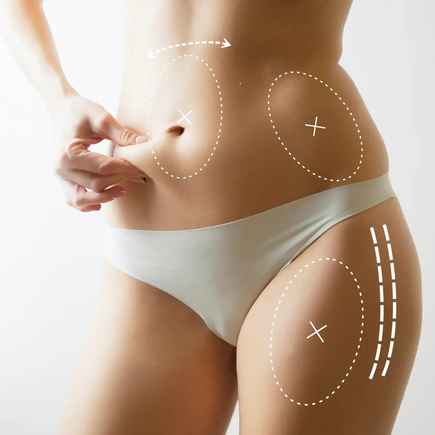Liposuction - Liposculpture treatment image