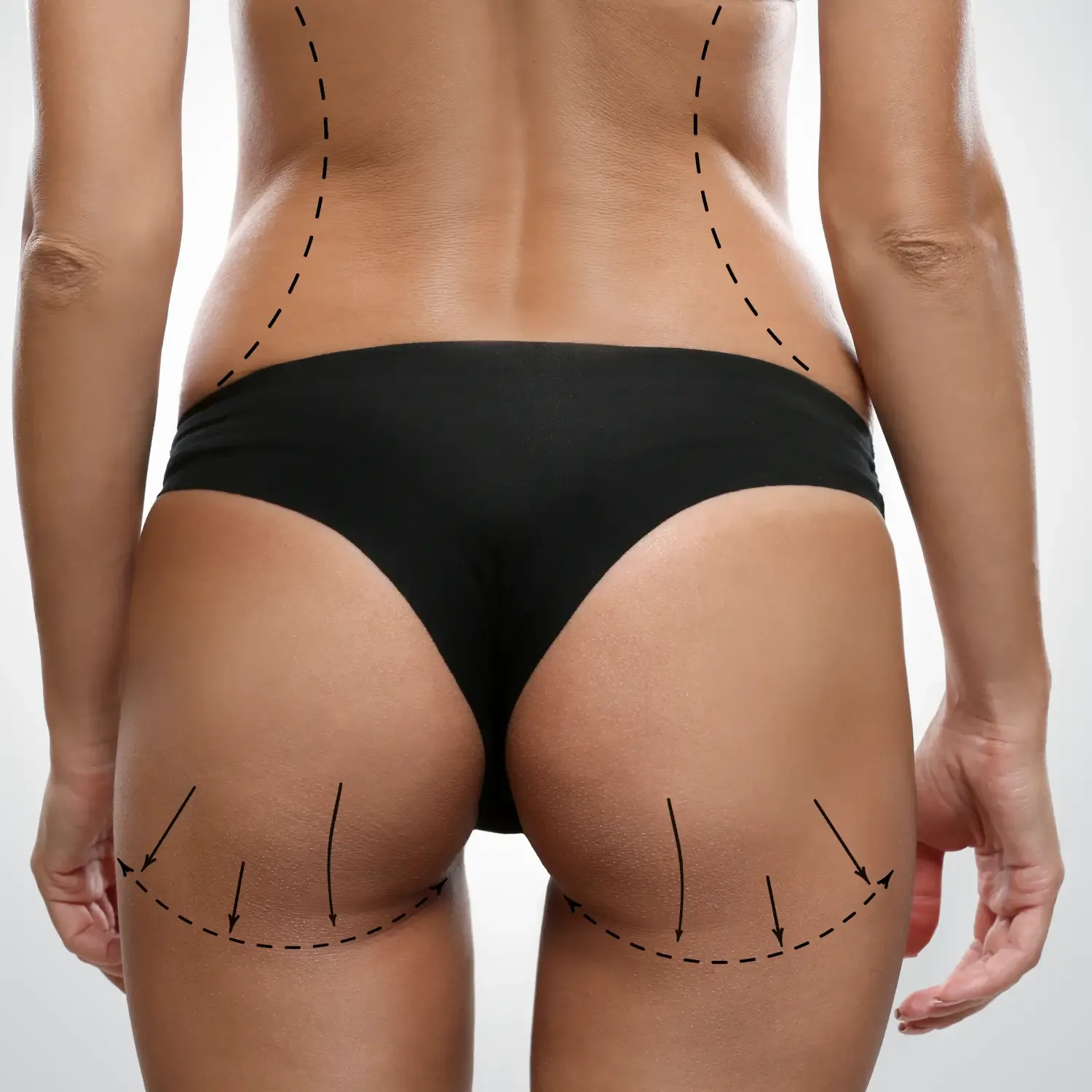 Vaser HD - Liposuction treatment image
