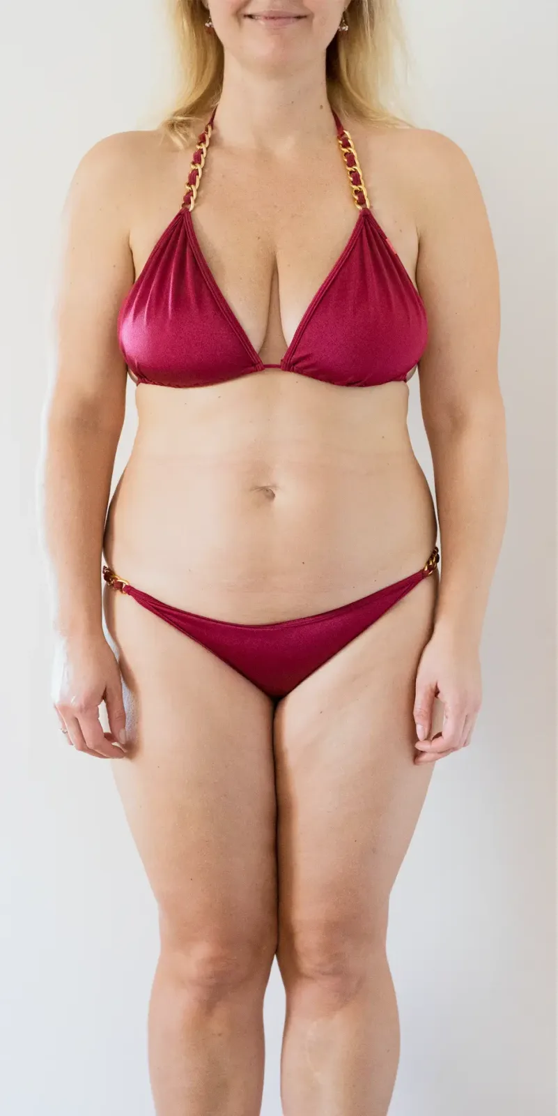 Gastric Sleeve after treatment comparison image