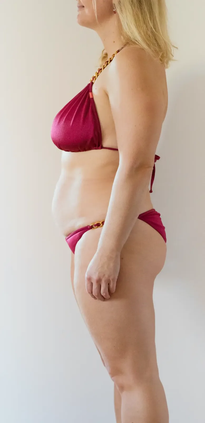 Gastric Sleeve after treatment comparison image