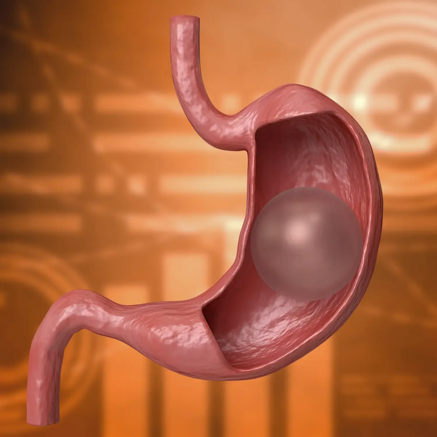 Gastric Balloon treatment image