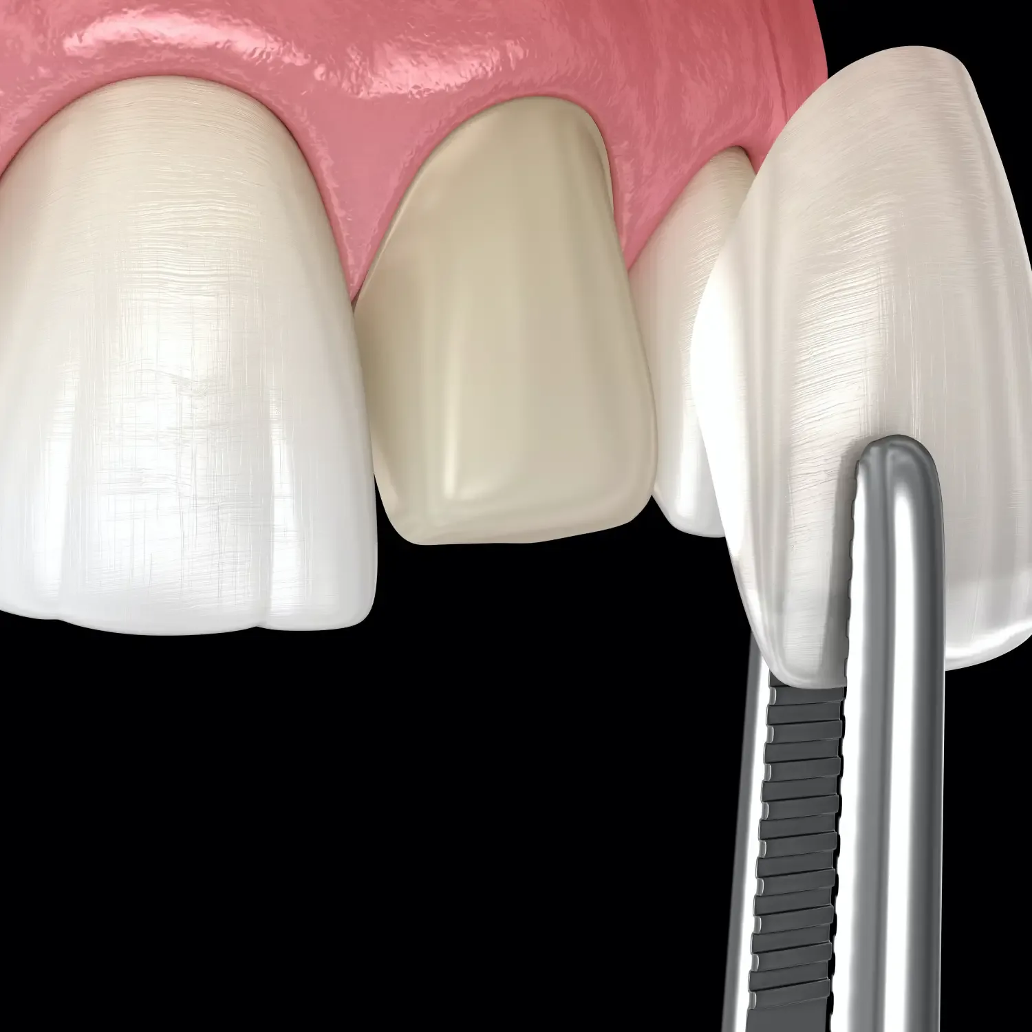 Veneers treatment image