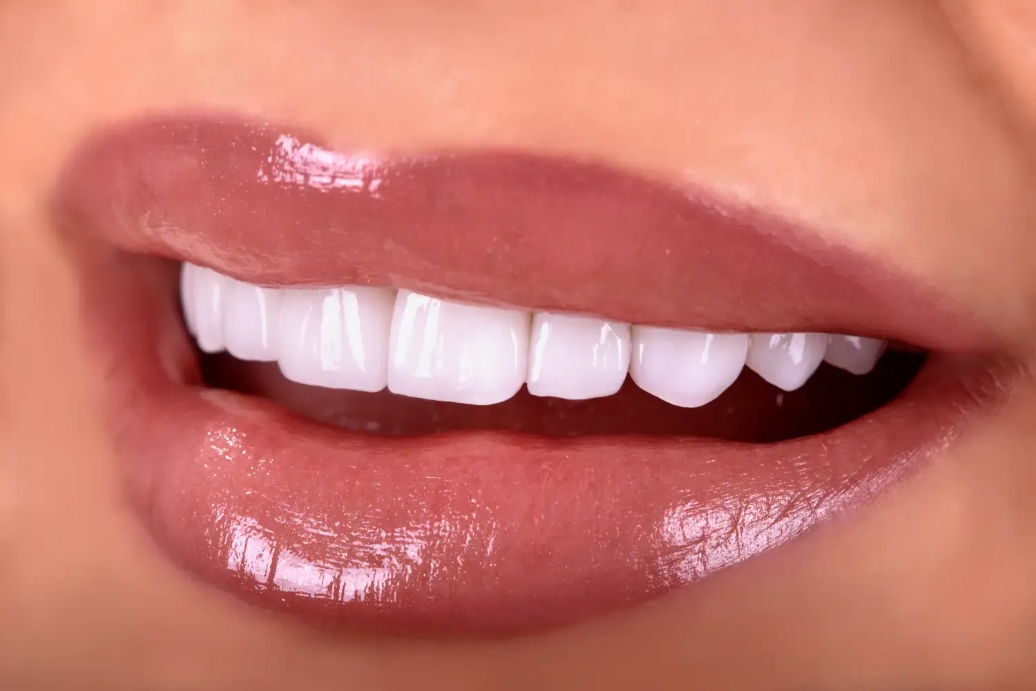 Emax Crowns treatment image