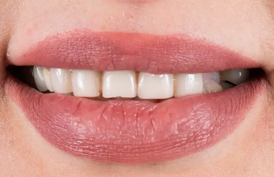 Emax Crowns after treatment comparison image