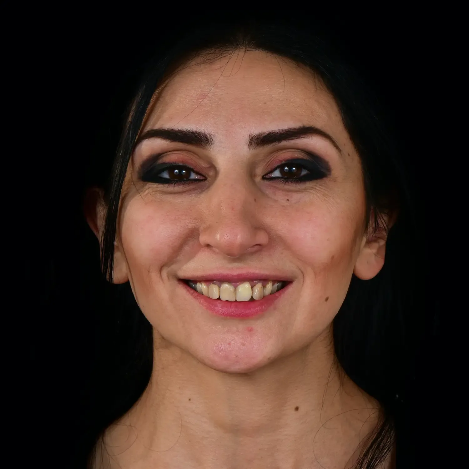 Veneers after treatment comparison image