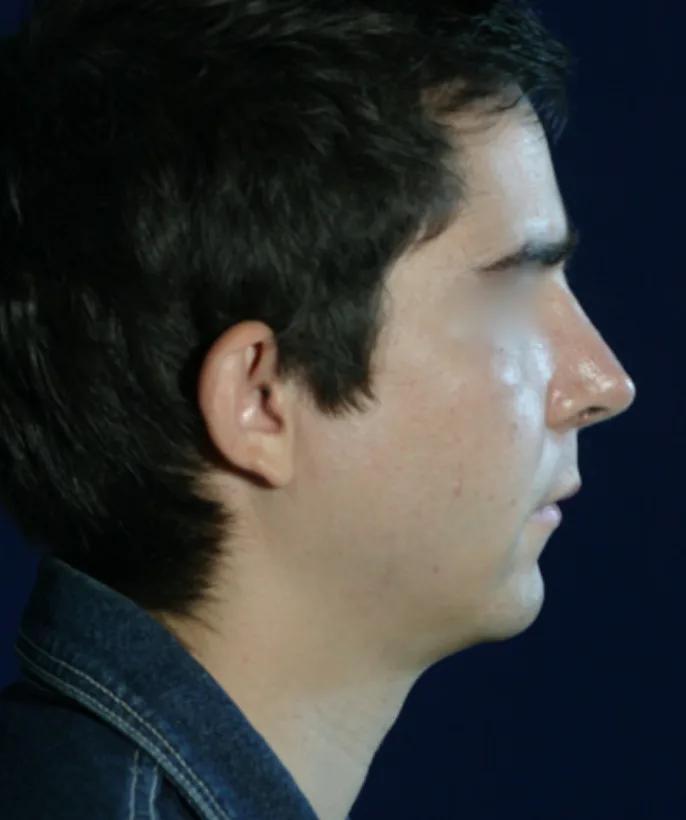 Rhinoplasty before treatment comparison image