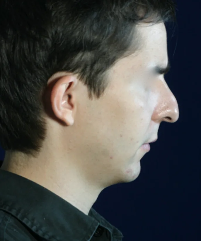 Rhinoplasty after treatment comparison image