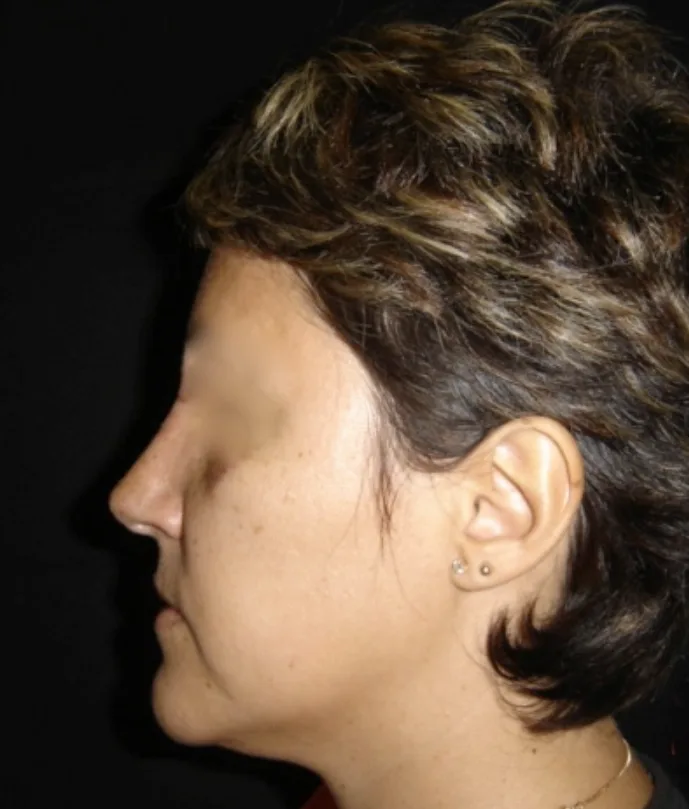Rhinoplasty before treatment comparison image