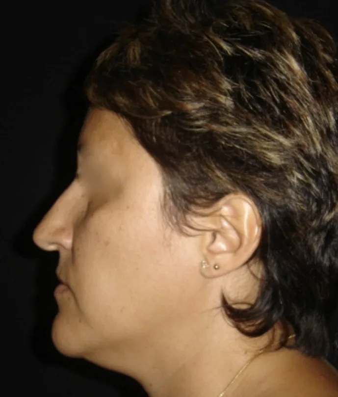 Rhinoplasty after treatment comparison image