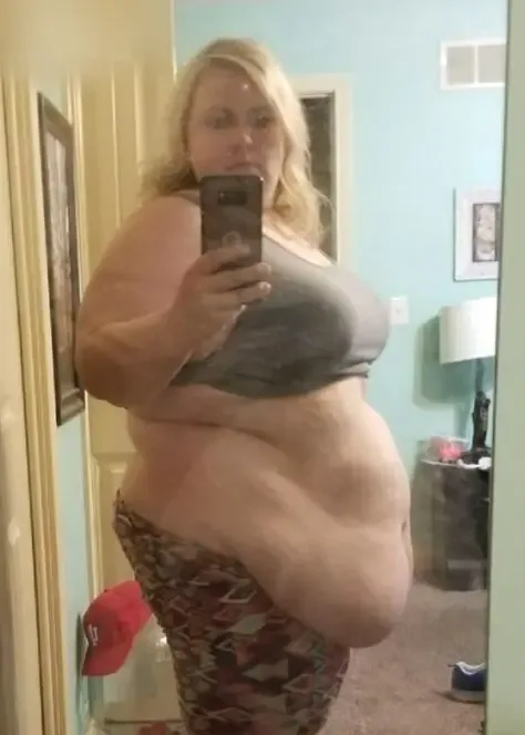 Gastric Band after treatment comparison image